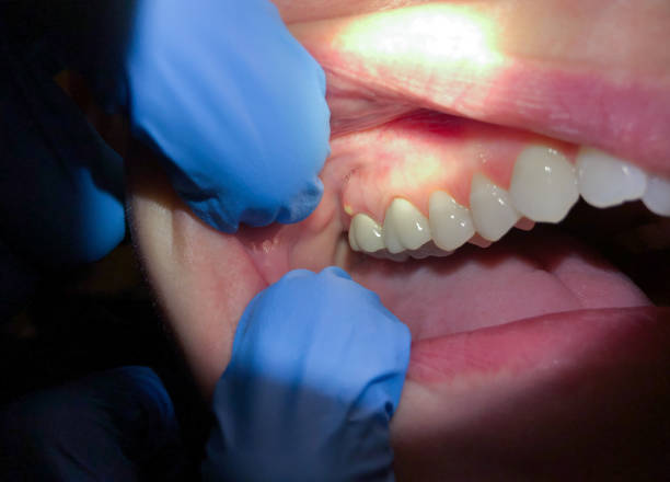 Best Emergency Dental Extractions in Mountville, PA